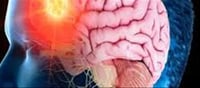 Brain Stroke Warning Signs: Early Symptoms You Should Never Ignore
